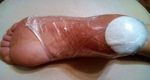 Грибок на пятках (микоз): причины появления, как возникают симптомы, лечение мазью и др. 4