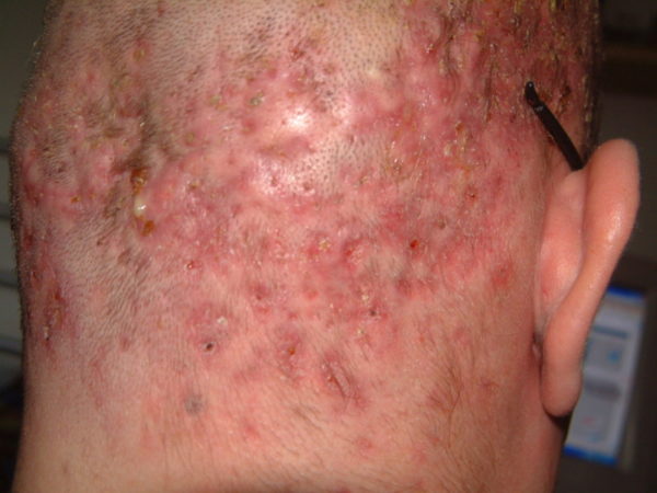 Остиофолликулит: лечение и профилактика стафилококкового импетиго 4