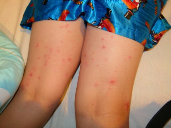 Зуд внутренней поверхности бедра у женщин: причина явления, с каким врачом обратиться 1