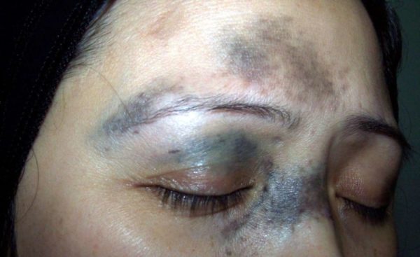 Виды родинок у человека: доброкачественные и злокачественные 11