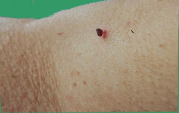 Упал крот: причины, первая помощь, методы лечения7