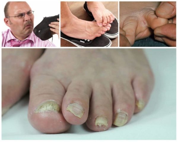 Какие народные средства от грибка помогают избавиться от инфекции самостоятельно