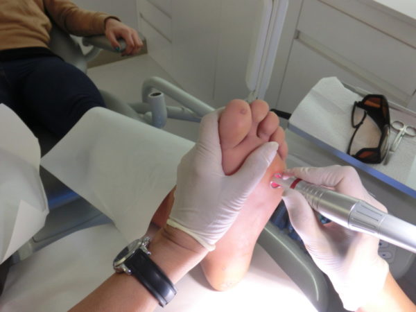 Подошвенная бородавка на ноге: как выглядит, удаление в домашних условиях 5