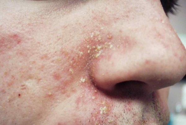 Какая мазь от себорейного дерматита быстро снимает шелушение и покраснение 0