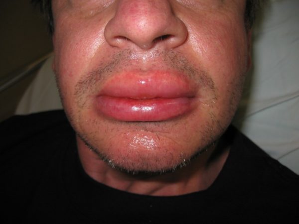 Отек Квинке: симптомы, опаснейшая локализация отека Квинке, лечение болезни 4