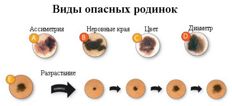 Родинка на безымянном пальце правой руки мужчины и женщины: что значит, методы удаления