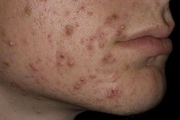 Как быстро избавиться от прыщей и черных точек: косметика, народные методы