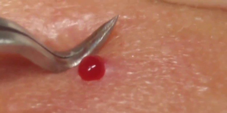 Выдавила прыщик, появилась болячка: как быстро убрать прыщи и ускорить заживление ран3