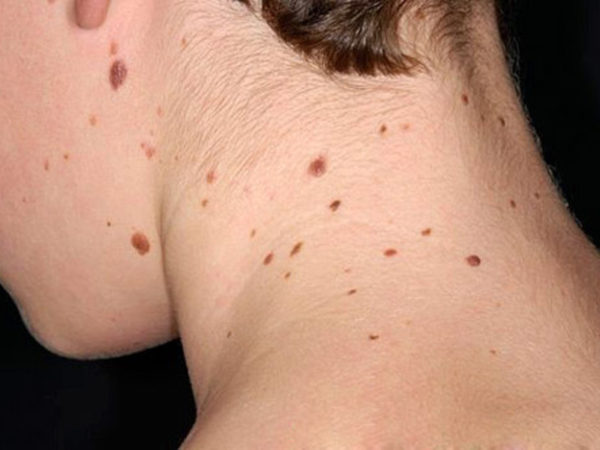 Виды родинок у человека: доброкачественные и злокачественные 5
