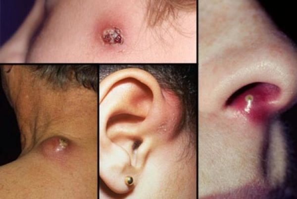 Рецидивирующий фурункулез: обследование и лечение хронического заболевания