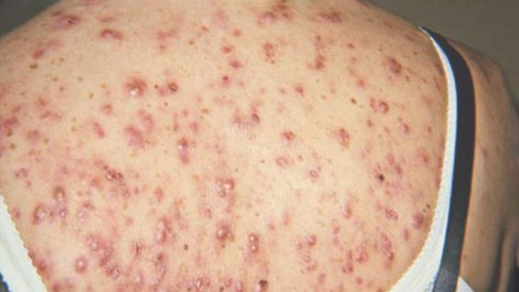 Синтомициновая мазь от прыщей (прыщей): инструкция по применению от прыщей на лице 2