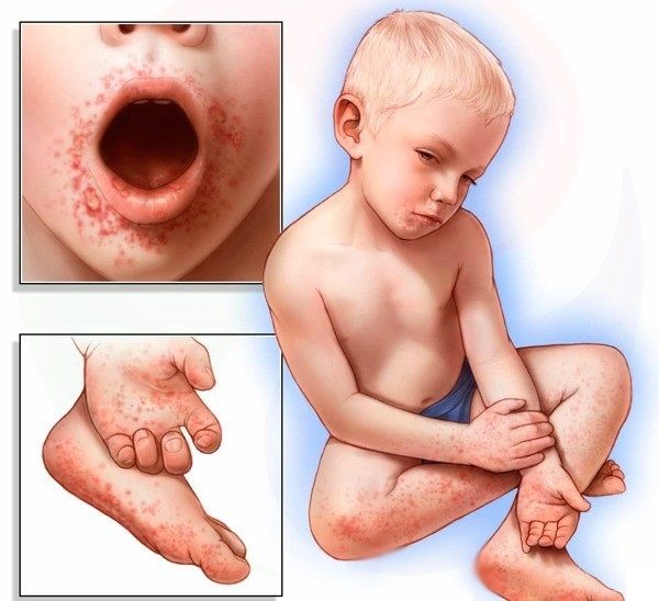 Вирус Коксаки может течь без температуры4