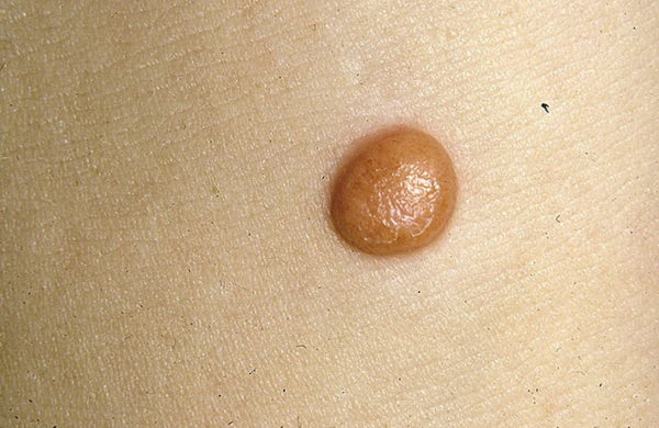 Виды родинок у человека: доброкачественные и злокачественные 8