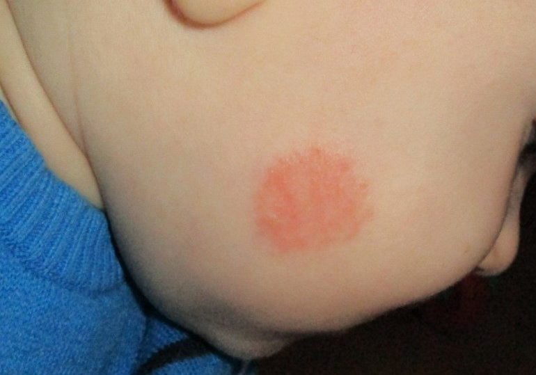 Пятна на коже похожи на лишай и не чешутся: что это может быть, какие заболевания похожи на лишай3