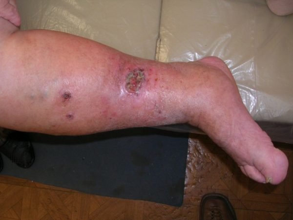 Трофическая язва ног при сахарном диабете: лечение, диета в домашних условиях 1