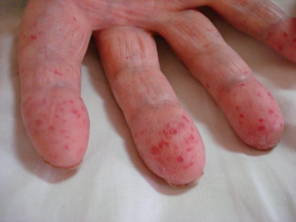 Синяки на ногах без причины у женщин: что это может быть, при каком заболевании возникают6