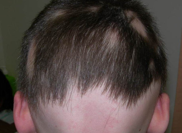 Лишай на голове: причины патологии, симптомы, методы терапии в домашних условиях4