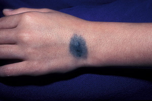 Виды родинок у человека: доброкачественные и злокачественные 12