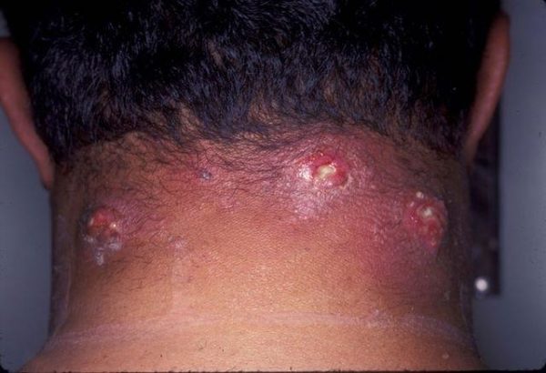 Антибиотики при фурункулезе: как лечить гнойные образования 3