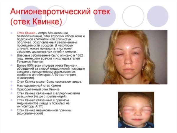 Ангионевротический отек: симптомы, опаснейшая локализация отека Квинке, лечение болезни 3