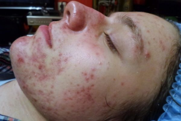 Пигментные пятна на лице: причины и лечение в домашних условиях 3