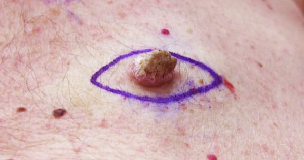 Воспаленная папиллома: причины воспаления, что делать