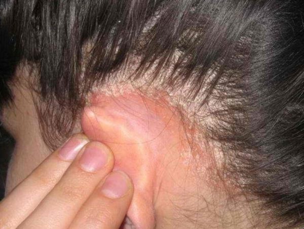 Себорейная алопеция у мужчин и женщин: симптомы, причины развития, методы терапии 2