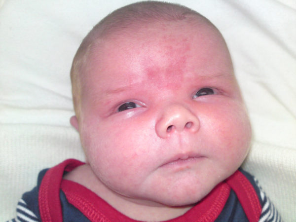 Невус: что это такое, причины образования, виды, симптомы возрождения9