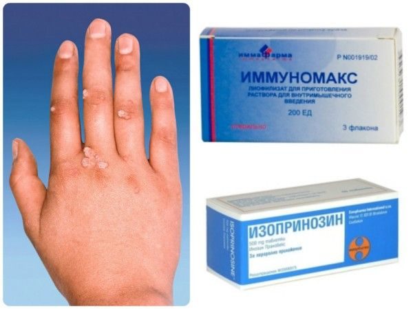 Препараты от бородавок на руках: мази, свечи, таблетки и другие средства