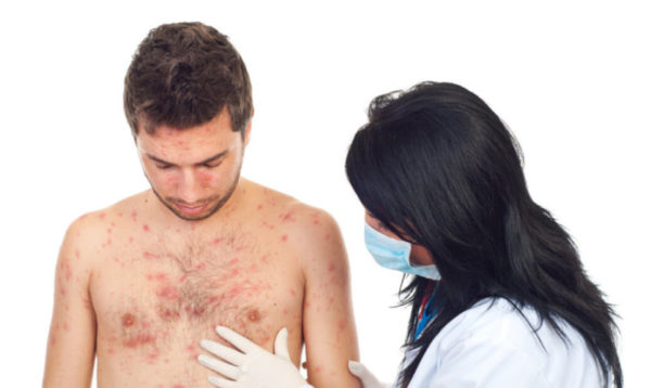 Как быстро и эффективно вылечить розацеа из лишая у человека в домашних условиях