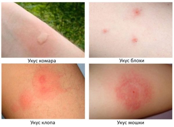 Зуд внизу живота у женщин: причины, как избавиться от неприятного симптома