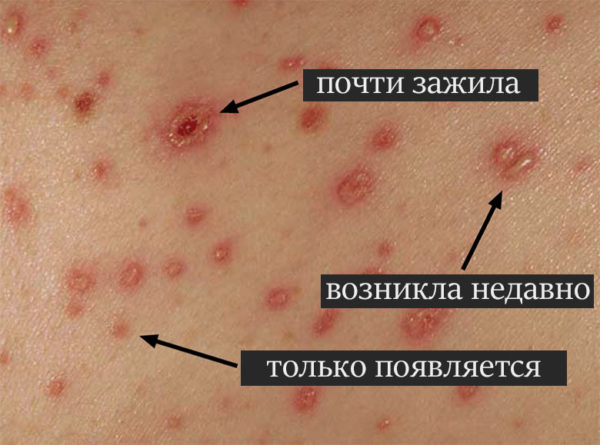 Различия между ветряной оспой и аллергией и другими подобными заболеваниями 3
