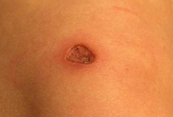 Электрокоагуляция папиллом: как происходит удаление и есть ли осложнения 7