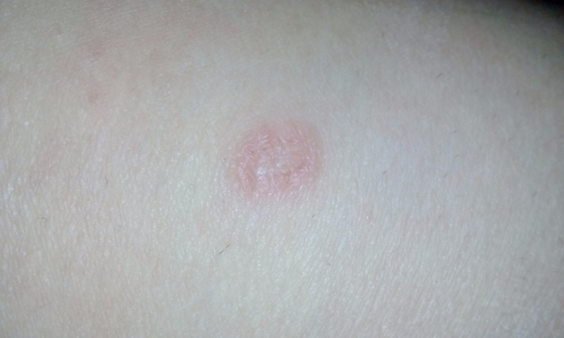 Как понять, что опоясывающий лишай у человека: сколько времени нужно, чтобы зажить от болезни