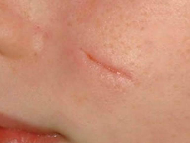 Рубец после удаления родинки: какие шрамы остаются после операции, как удалить их лазером, мази2