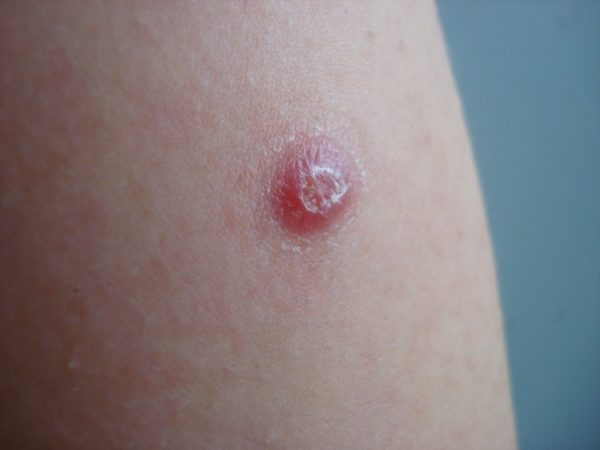 Вакцинация против краснухи: когда и как часто вводить взрослым 8