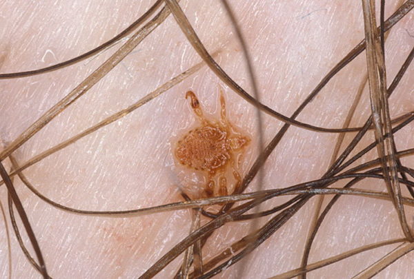 Зуд в лобковой части у женщин: причины, к которому обратиться к врачу4