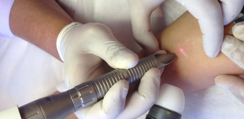 Рубец после удаления родинки: какие шрамы остаются после операции, как их удалить лазером, мази3