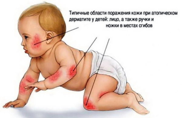 Атопический дерматит у взрослых и детей: особенности развития, методы терапии 6