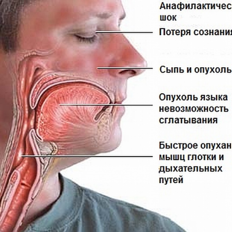Отек Квинке: симптомы у детей, как оказать первую помощь 3