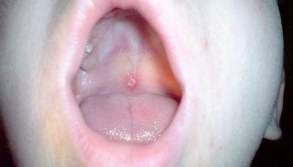 Инкубационный период ветрянки: сколько времени нужно, чтобы заболевание проявилось у детей и взрослых 6