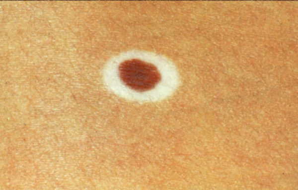 Виды родинок у человека: доброкачественные и злокачественные 9