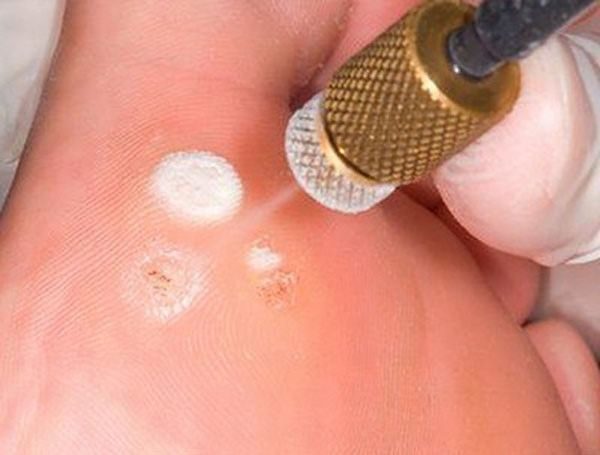 Подошвенная бородавка на ноге у ребенка: как от нее избавиться и чем лечить