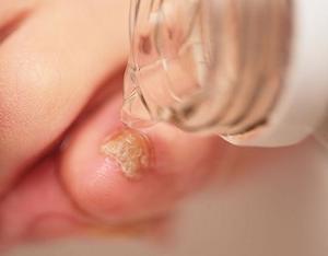 Способы избавления от грибка на ногах народными средствами: рецепты, помогающие в борьбе с недугом7