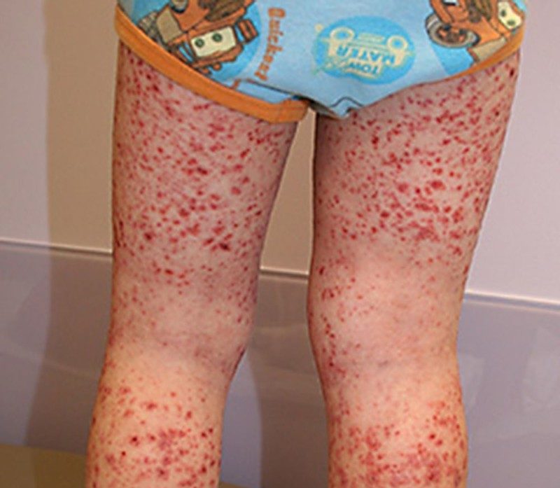 Хронический васкулит: какие препараты следует принимать, характеристика заболевания, симптомы, методы профилактики 1