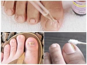 Капли от грибка ногтей: правила выбора, названия, применение средств от онихомикоза ногтей на ногах4