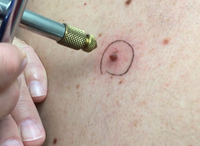 можно выдергивать волосы из родинки