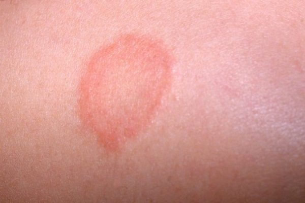 Розовый лишай на лице и голове: симптомы и лечение 2