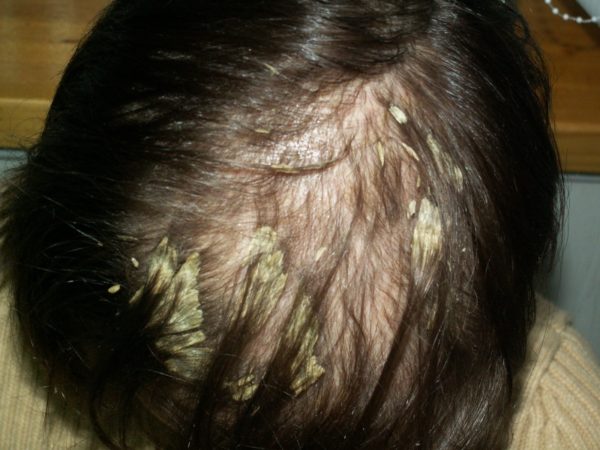 Лишай на голове: причины патологии, симптомы, методы терапии в домашних условиях7