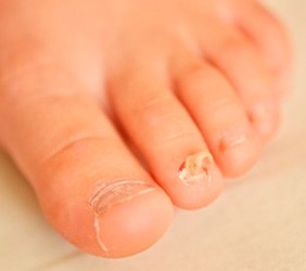 Грибок на ногтях стоп и рук: как выявить заболевание, выделить стадии развития